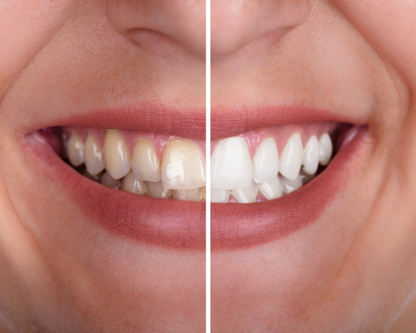 Clareamento Dental