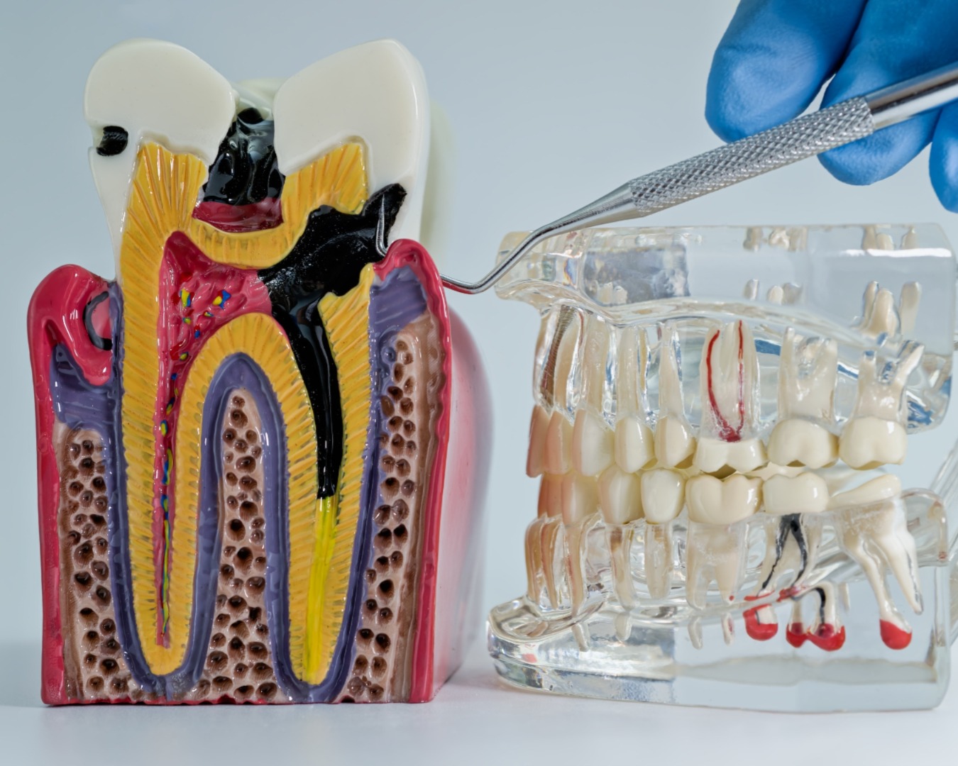 Endodontia (Canal)