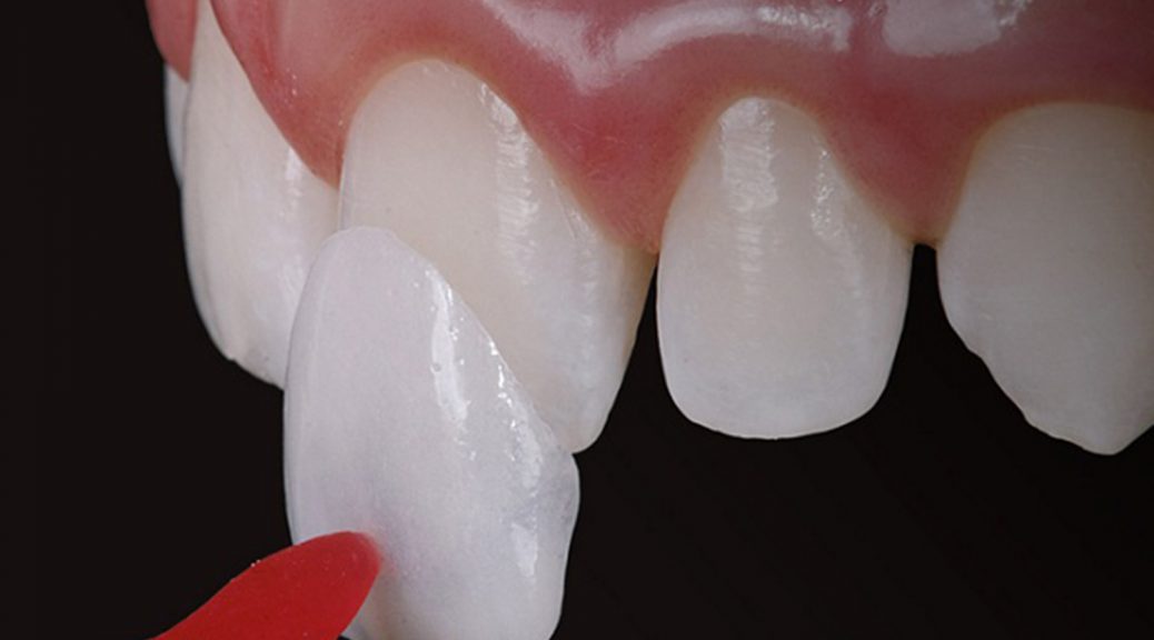Lentes de Contato Dental e Facetas em Ubá